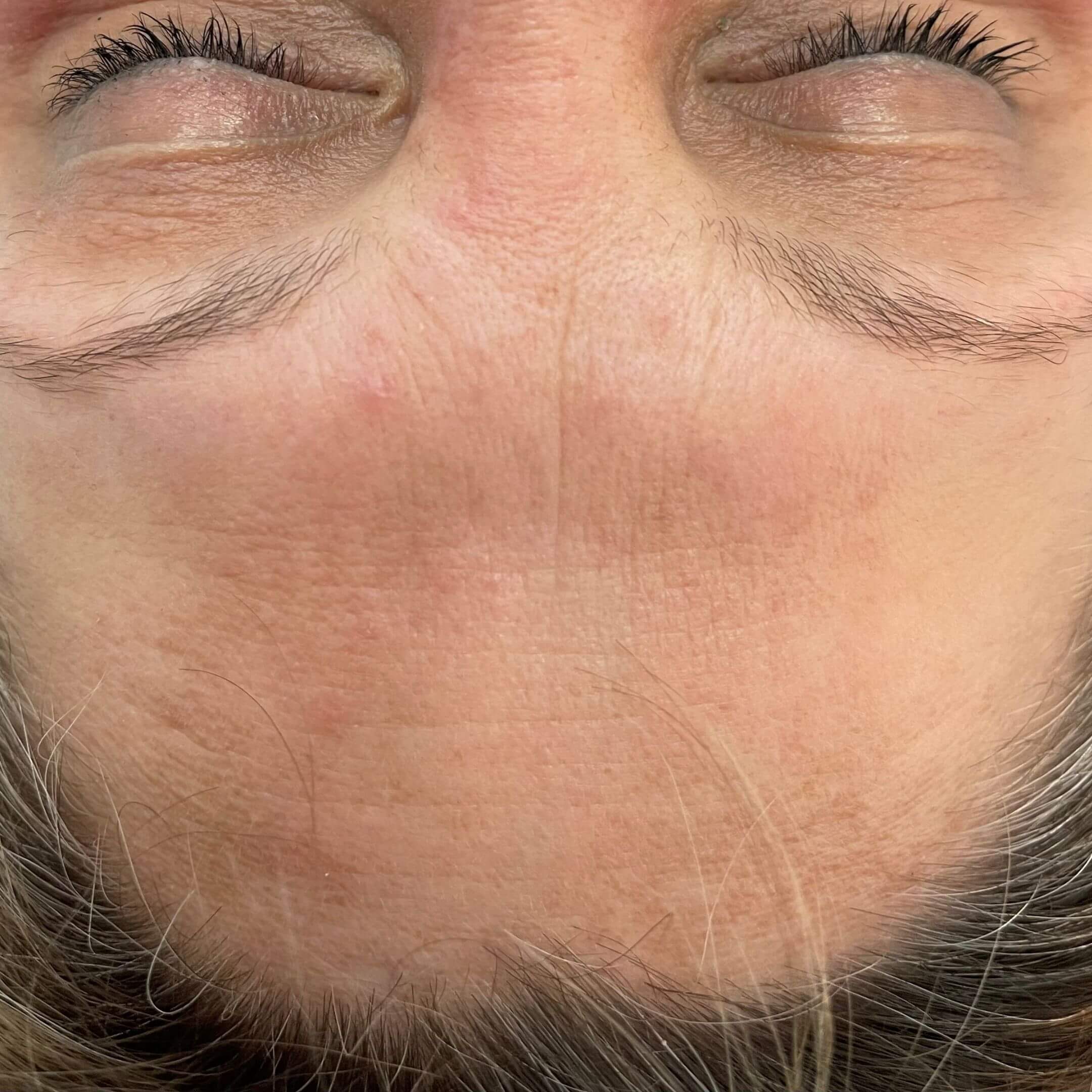 Terapie łączone na twarz