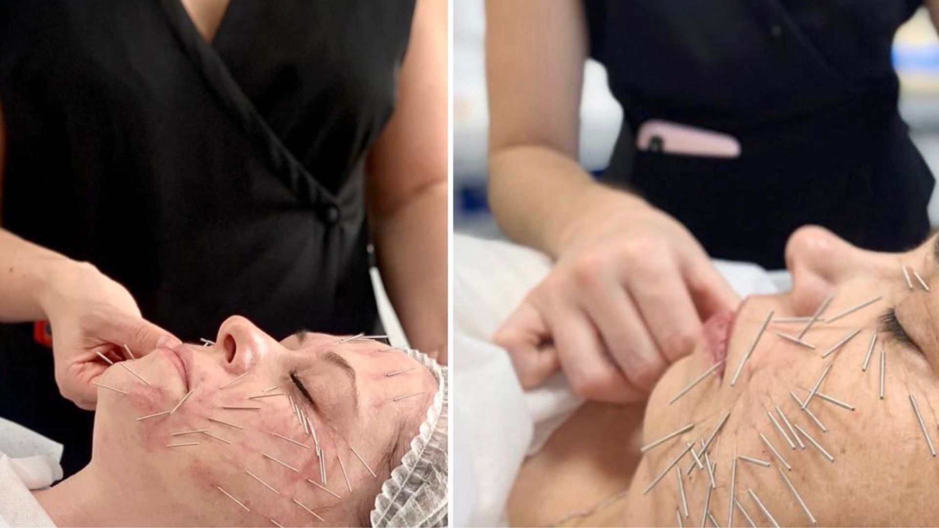 needle shaping - jak wygląda zabieg?