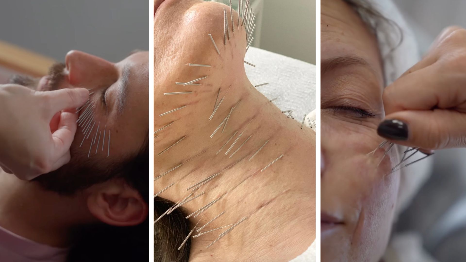 autologiczne nici kolagenowe opinie